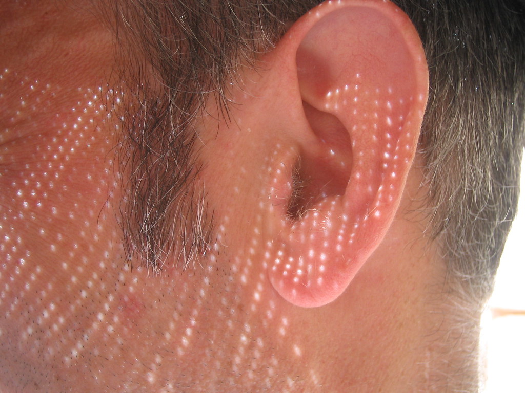 Hydrogen Peroxide in your ear…. is it&nbsp;safe?
